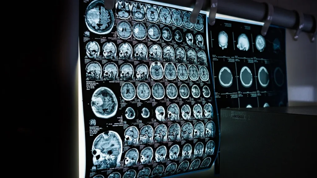 Brain MRI scans on a lightbox in a clinical setting, symbolizing patient care.