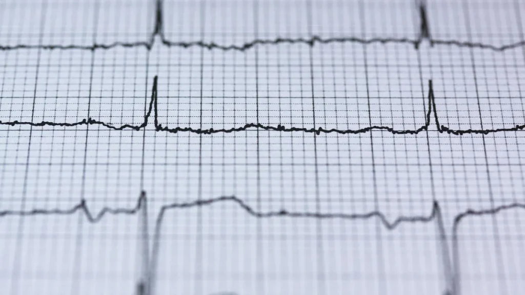 Close-up of an electrocardiogram (ECG) printout showing heart rhythm lines on grid paper.
